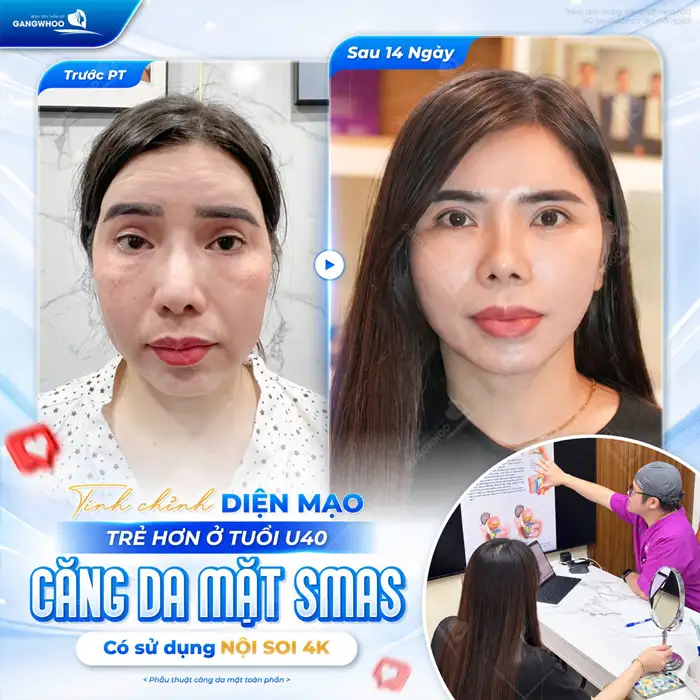 Căng Da Mặt Có Hại Không? Điều Cần Lưu Ý Để Căng Da Mặt An Toàn