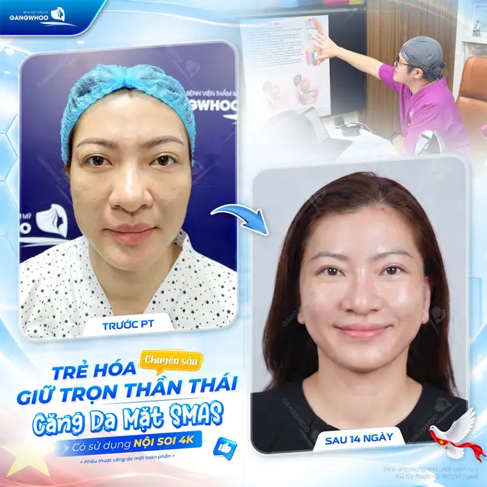 Căng Da Mặt Có Hại Không? Điều Cần Lưu Ý Để Căng Da Mặt An Toàn