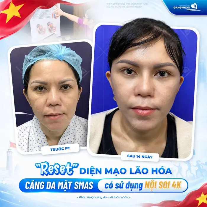 Căng Da Mặt Bao Lâu Thì Lành? Cách Chăm Sóc Da Mặt Hồi Phục Nhanh Hơn