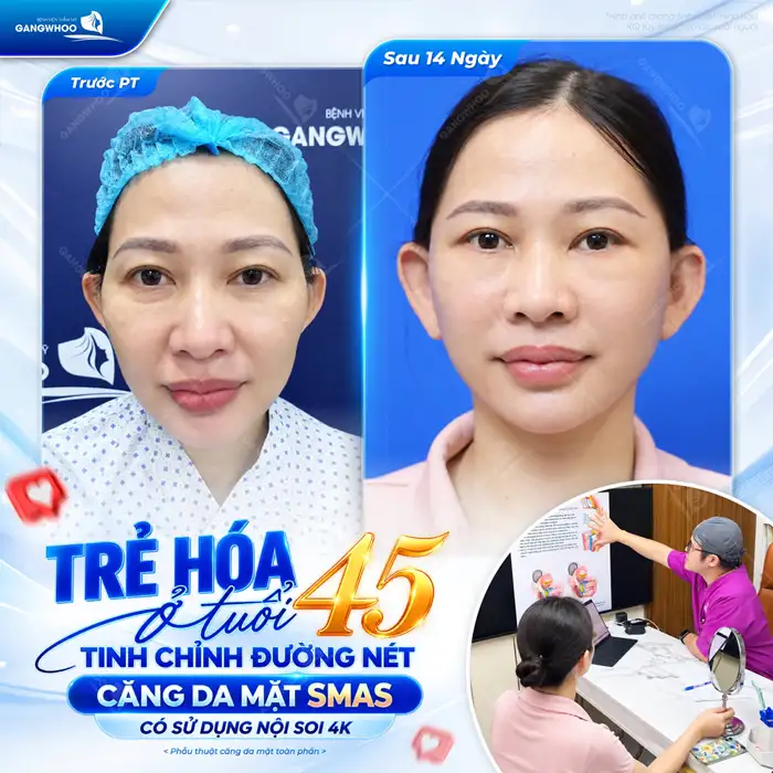 4 Tiêu Chí Để Lựa Chọn Địa Điểm Căng Da Mặt Ở Đâu tốt