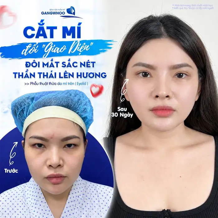 Cắt mí tự nhiên – ở đâu? Lời khuyên từ chuyên gia