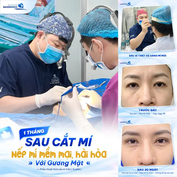 Cắt mí tự nhiên – ở đâu? Lời khuyên từ chuyên gia