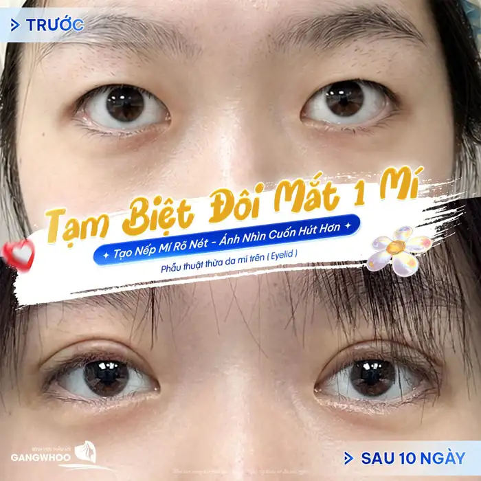 Cắt mí tự nhiên – ở đâu? Lời khuyên từ chuyên gia