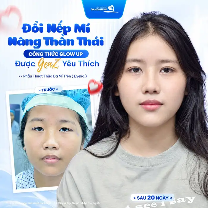 Cắt mí tự nhiên – ở đâu? Lời khuyên từ chuyên gia