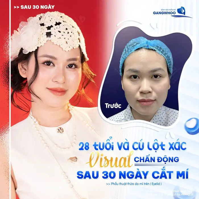 Cắt mí tự nhiên – ở đâu? Lời khuyên từ chuyên gia