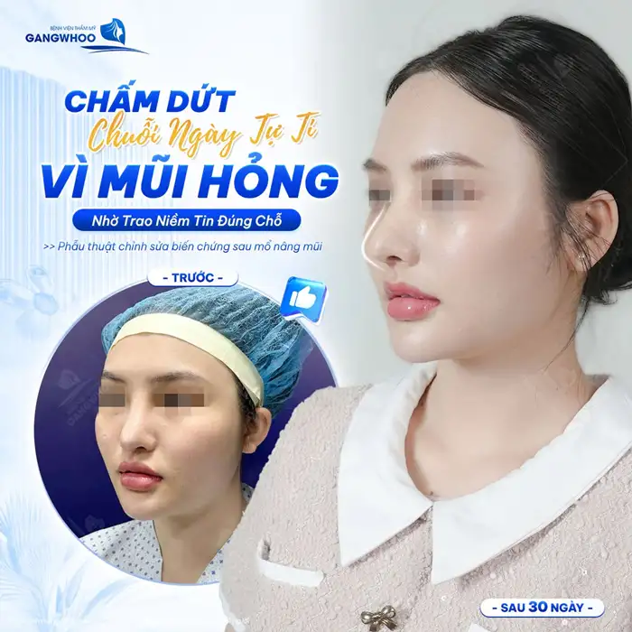 Sửa mũi hỏng ở đâu? Top 5 địa chỉ sửa mũi hỏng uy tín tại Tphcm