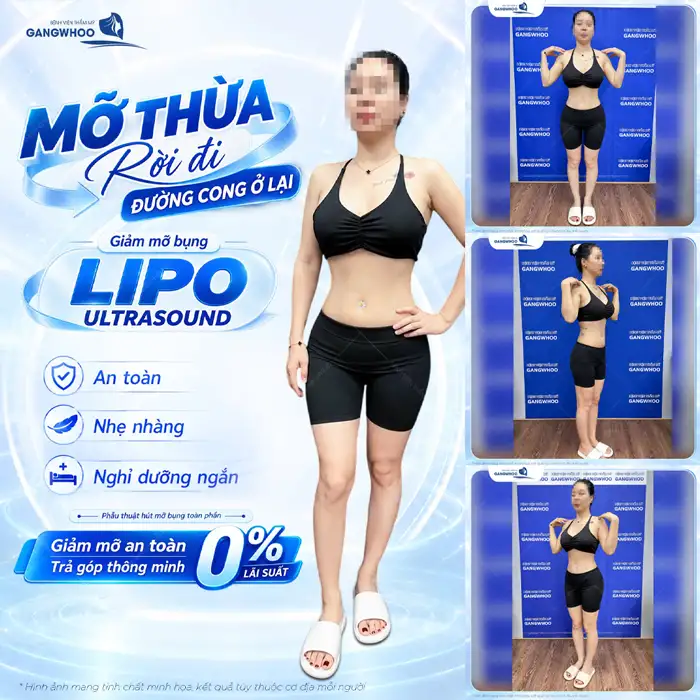 Top 10 những điều cần biết khi hút mỡ bụng