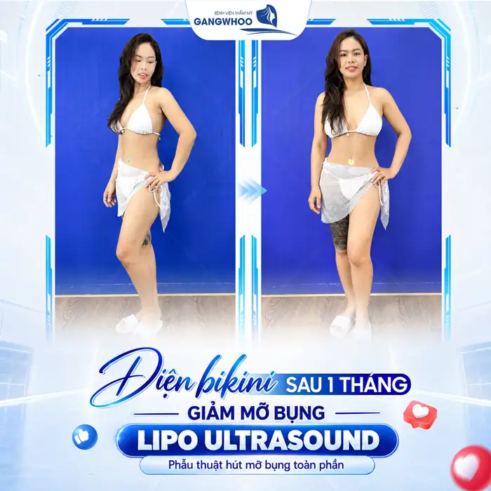 Top 10 những điều cần biết khi hút mỡ bụng