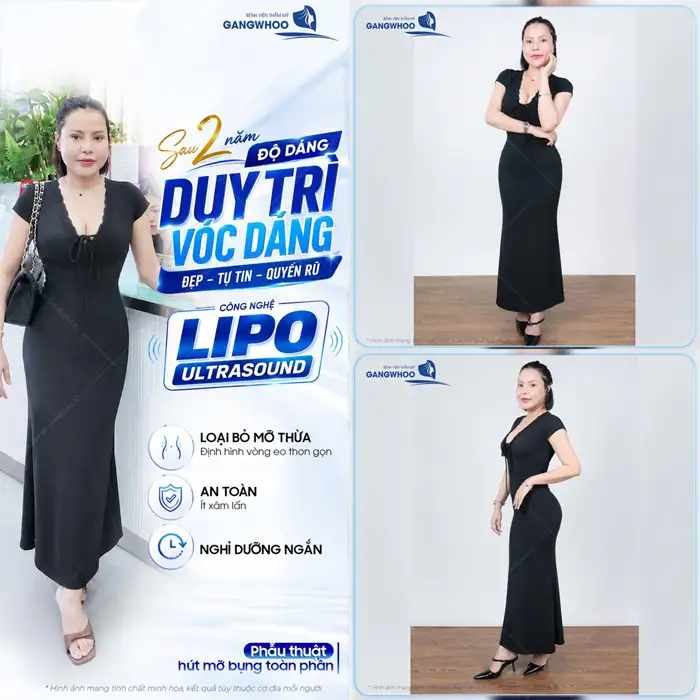Top 10 những điều cần biết khi hút mỡ bụng