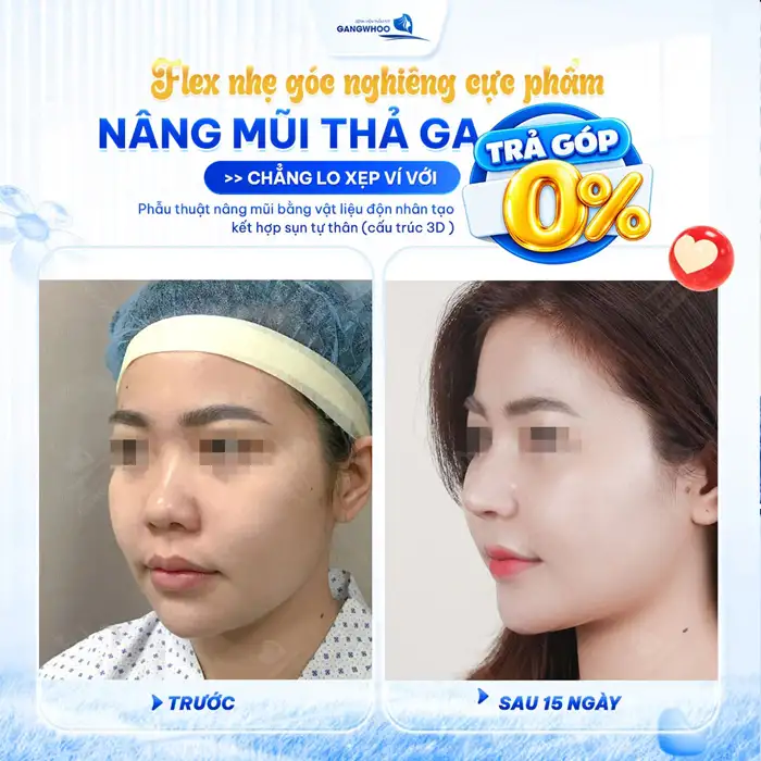 Nâng mũi ở đâu đẹp uy tín và an toàn tại Sài Gòn?
