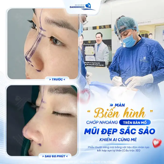 Phương pháp nâng mũi tốt hiện nay