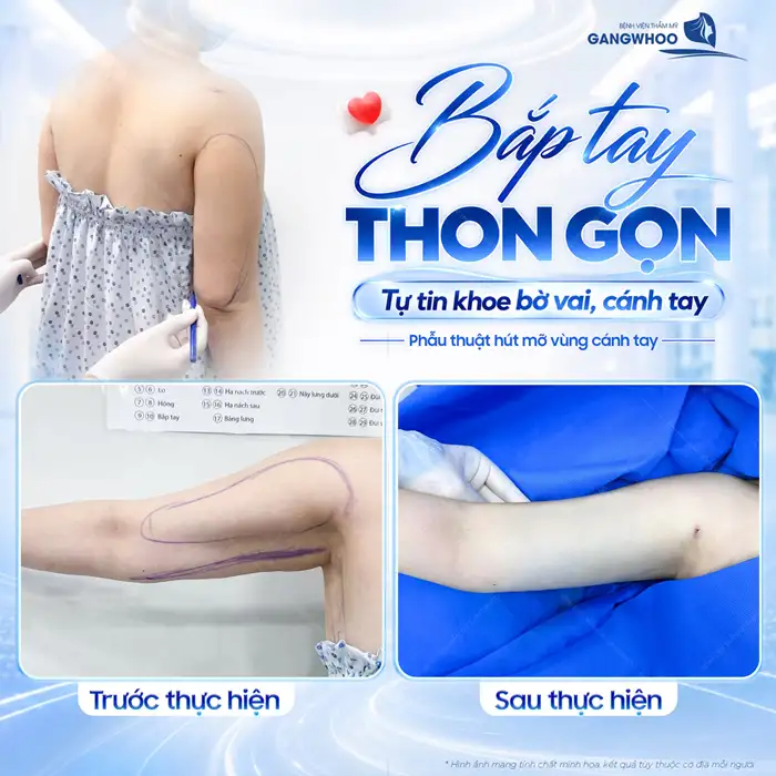 Hút Mỡ “Lột Xác” Hóa Eo Thon Gọn An Toàn, Nhanh Chóng