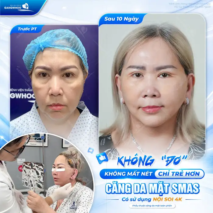 Căng Da Mặt – Giải Pháp Lý Tưởng Cho Một Làn Da Trẻ Hóa