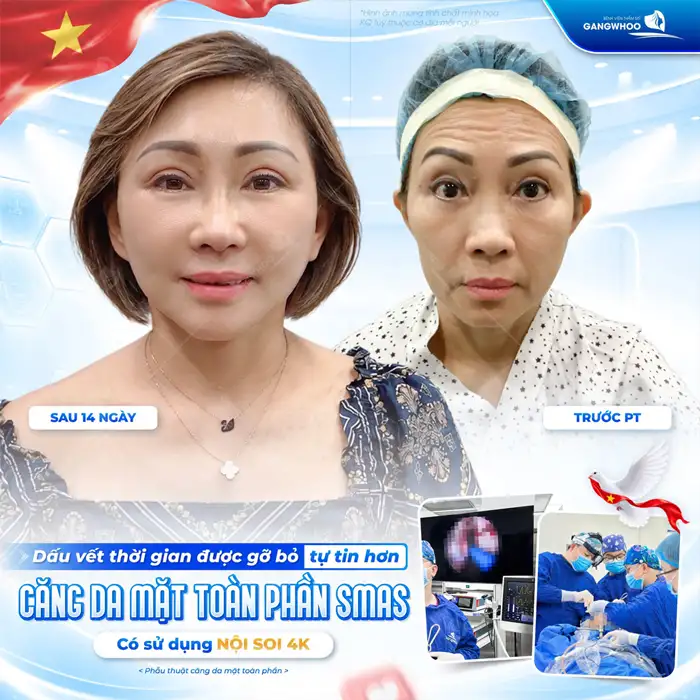 Căng Da Mặt – Giải Pháp Lý Tưởng Cho Một Làn Da Trẻ Hóa