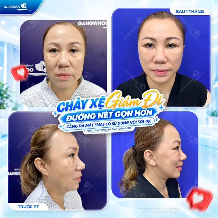 Căng Da Mặt Phẫu Thuật – Giải Pháp Cho Làn Da Nói Không Với Lão Hóa