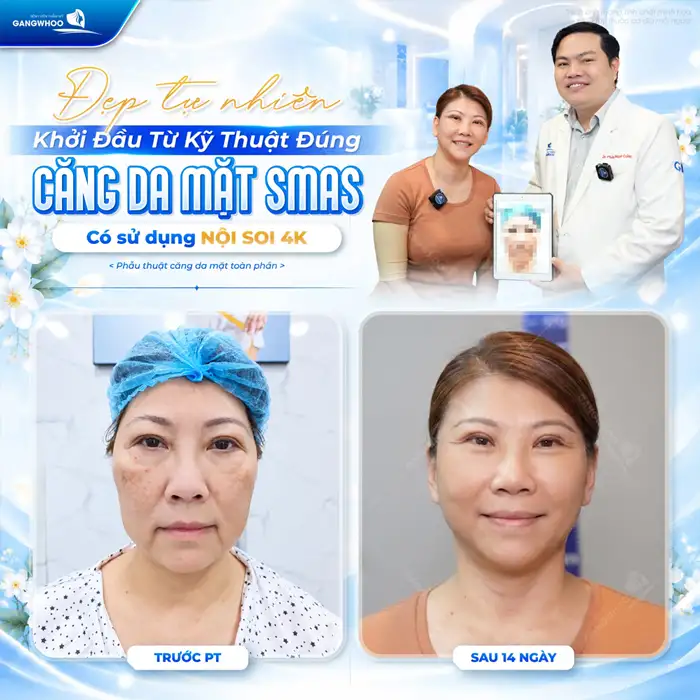 Căng Da Mặt – Giải Pháp Lý Tưởng Cho Một Làn Da Trẻ Hóa