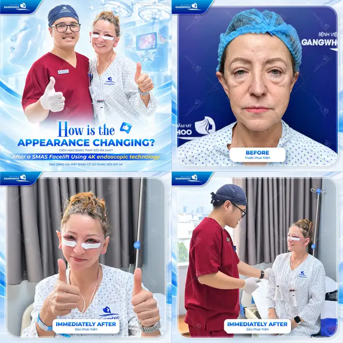 Căng Da Mặt Phẫu Thuật – Giải Pháp Cho Làn Da Nói Không Với Lão Hóa