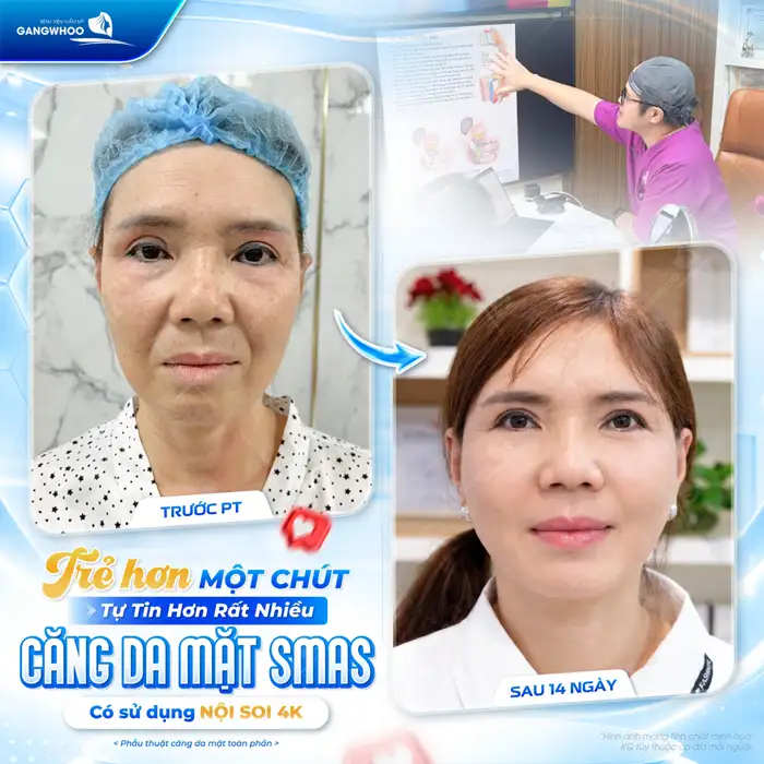 Căng Da Mặt – Giải Pháp Lý Tưởng Cho Một Làn Da Trẻ Hóa