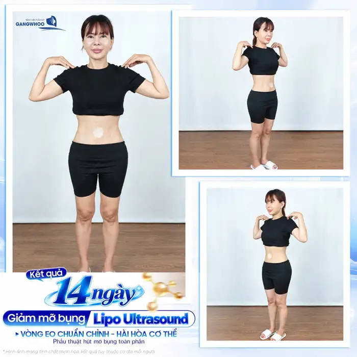 Hút Mỡ “Lột Xác” Hóa Eo Thon Gọn An Toàn, Nhanh Chóng