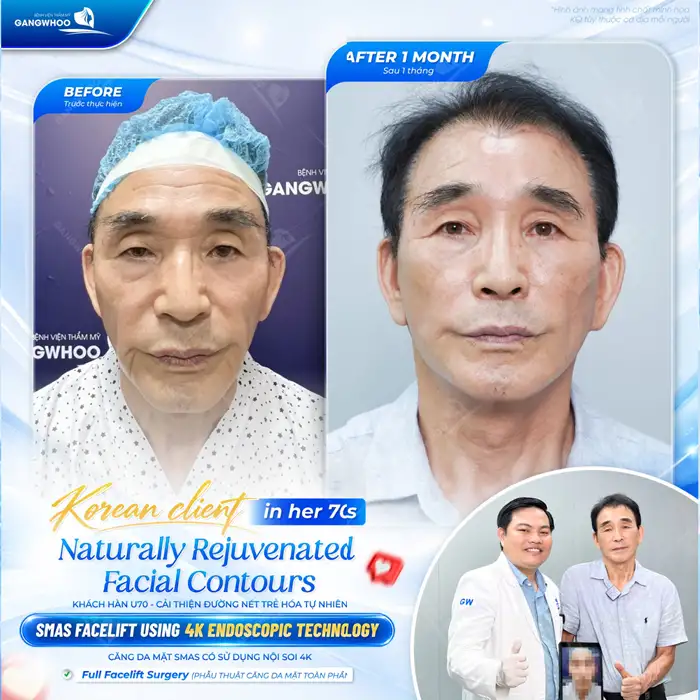 Căng Da Mặt Phẫu Thuật – Giải Pháp Cho Làn Da Nói Không Với Lão Hóa