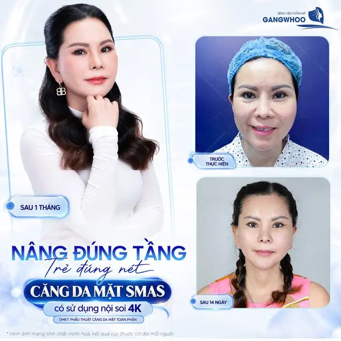 Căng Da Mặt – Giải Pháp Lý Tưởng Cho Một Làn Da Trẻ Hóa