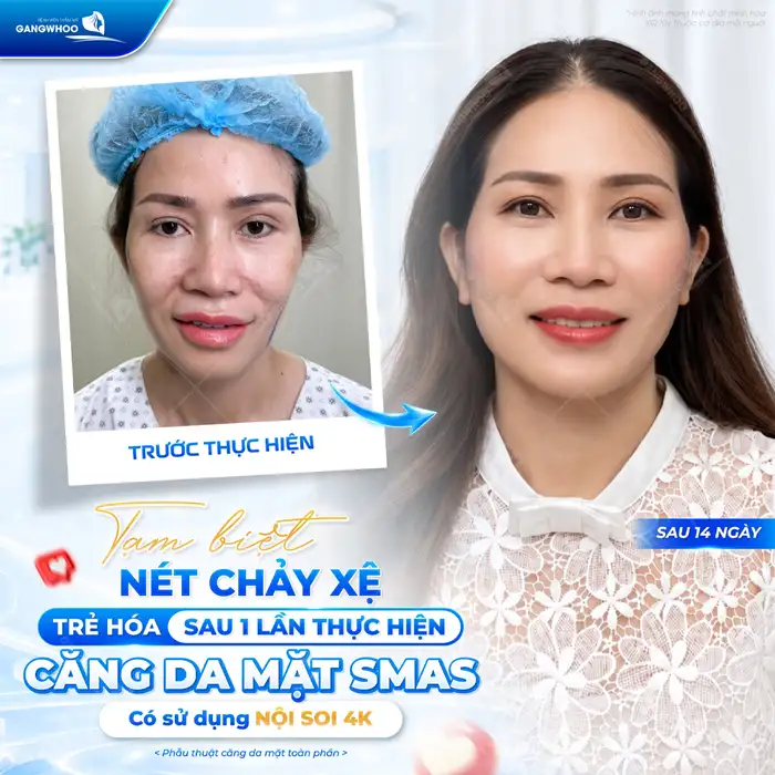 Căng Da Mặt Phẫu Thuật – Giải Pháp Cho Làn Da Nói Không Với Lão Hóa