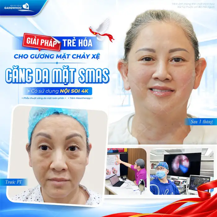 Căng Da Mặt Phẫu Thuật – Giải Pháp Cho Làn Da Nói Không Với Lão Hóa