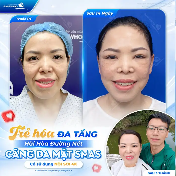 Căng Da Mặt – Giải Pháp Lý Tưởng Cho Một Làn Da Trẻ Hóa