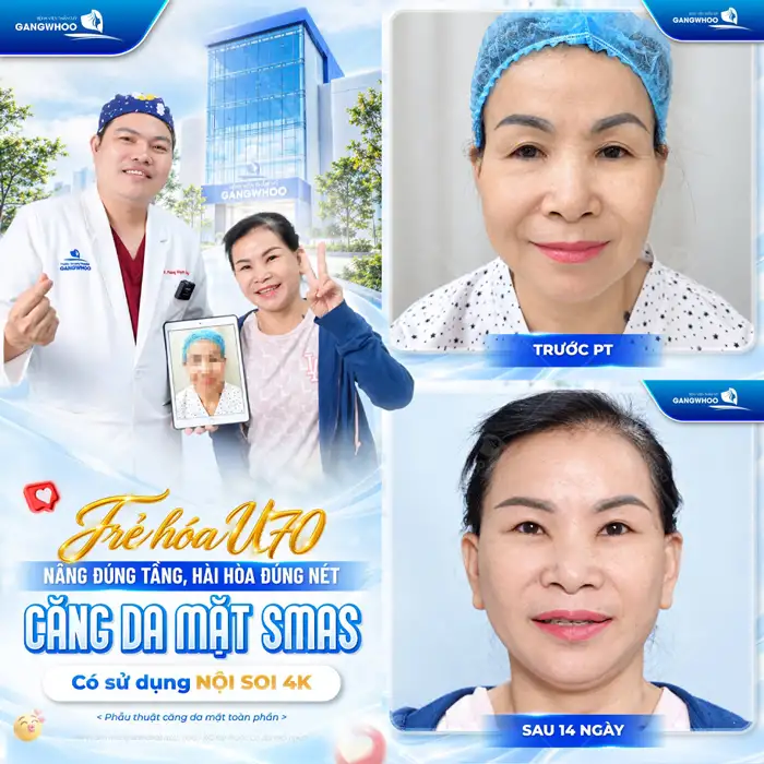 Căng Da Mặt – Giải Pháp Lý Tưởng Cho Một Làn Da Trẻ Hóa