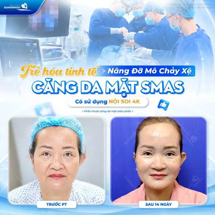 Căng Da Mặt Phẫu Thuật – Giải Pháp Cho Làn Da Nói Không Với Lão Hóa