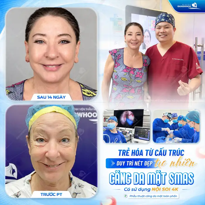 Căng Da Mặt – Giải Pháp Lý Tưởng Cho Một Làn Da Trẻ Hóa