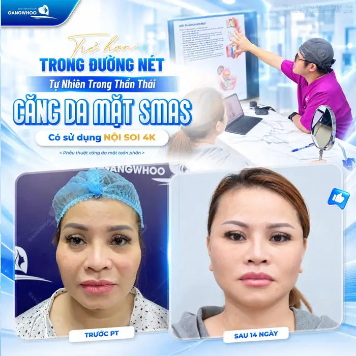 Căng Da Mặt – Giải Pháp Lý Tưởng Cho Một Làn Da Trẻ Hóa