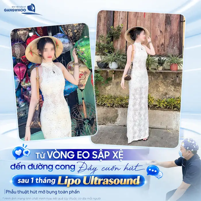 Hút Mỡ “Lột Xác” Hóa Eo Thon Gọn An Toàn, Nhanh Chóng