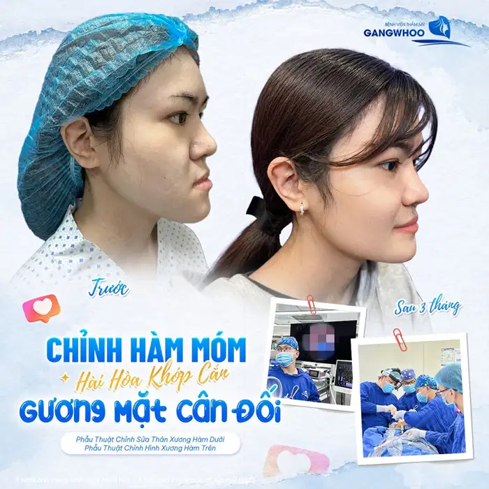 Gọt hàm có nguy hiểm không? Địa chỉ uy tín tại TP.HCM