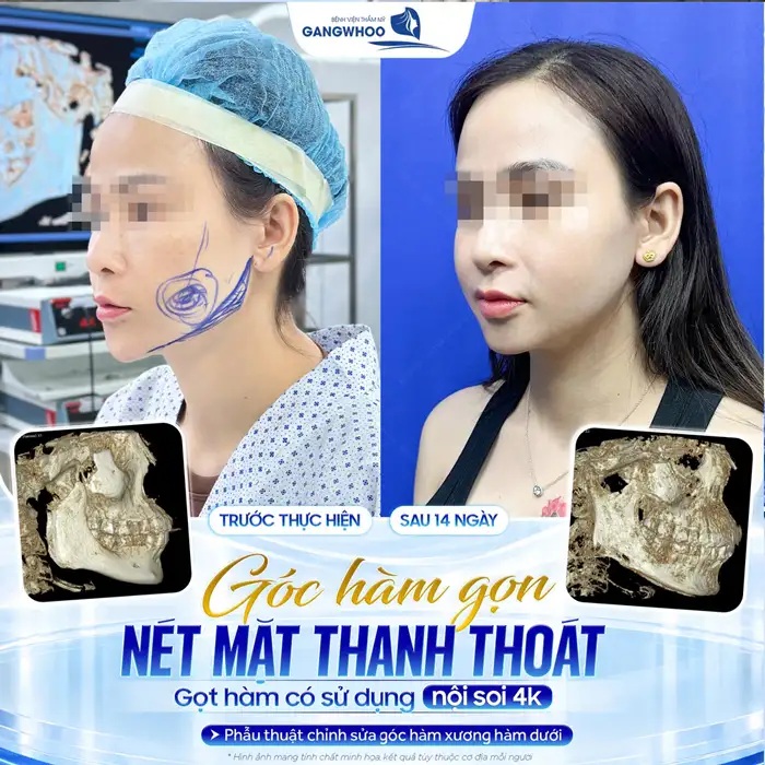 Gọt hàm có nguy hiểm không? Địa chỉ uy tín tại TP.HCM