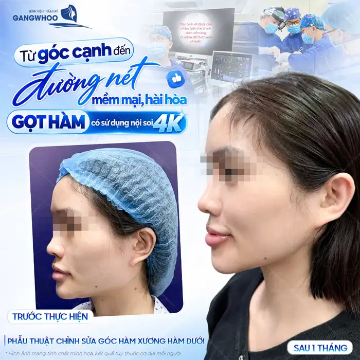Gọt hàm có nguy hiểm không? Địa chỉ uy tín tại TP.HCM