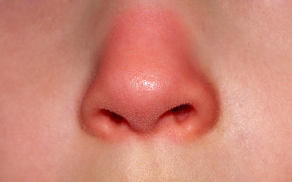 Mũi bị sưng và đau nhức là điều thường và chỉ kéo dài khoảng 2 - 7 ngày