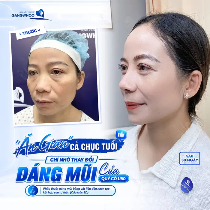Lớn Tuổi Có Nên Nâng Mũi Không? Cần Lưu Ý Gì Không?