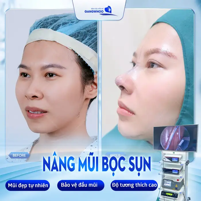 Có Nên Nâng Mũi Bọc Sụn Tai Đầu Mũi Không? Ai Nên Thực Hiện