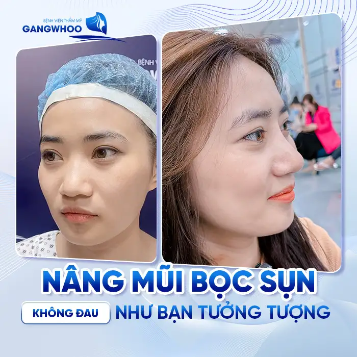 Nâng Mũi Bọc Sụn Có Đau Không? Lời Khuyên Của Bác Sĩ