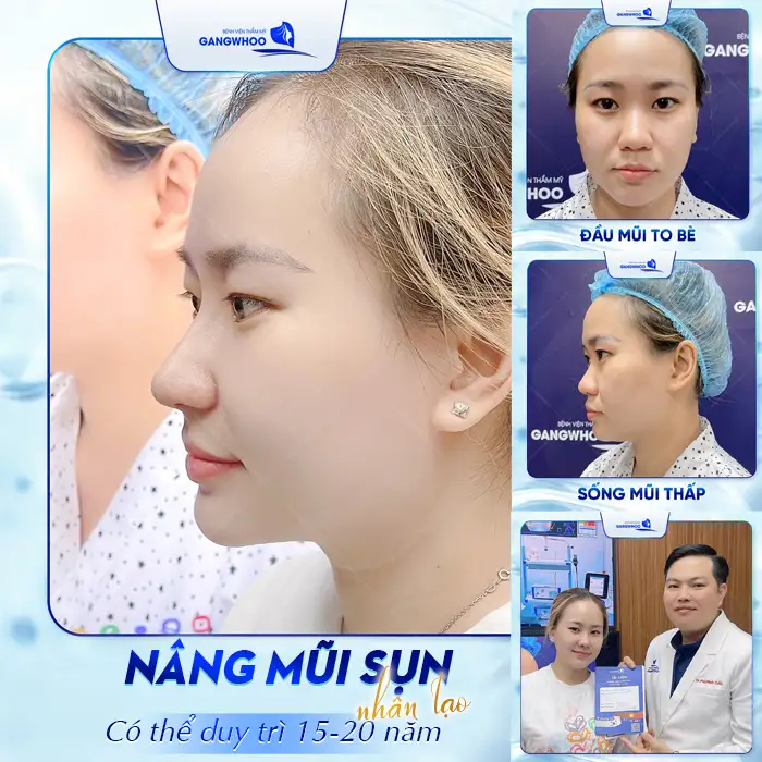 Nâng Mũi Sụn Nhân Tạo Giữ Được Bao Lâu? Có lâu dài Không?