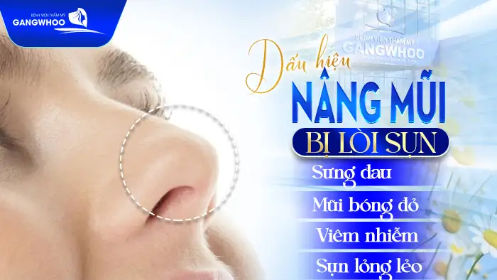 Dấu Hiệu Nhận Biết Nâng Mũi Bị Lòi Sụn & Cách Khắc Phục