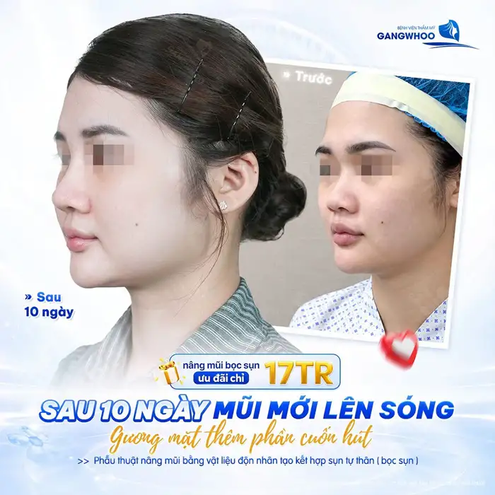 Nâng Mũi Cấu Trúc Có lâu dài Không? Cách Chăm Sóc Đẹp Dài Lâu