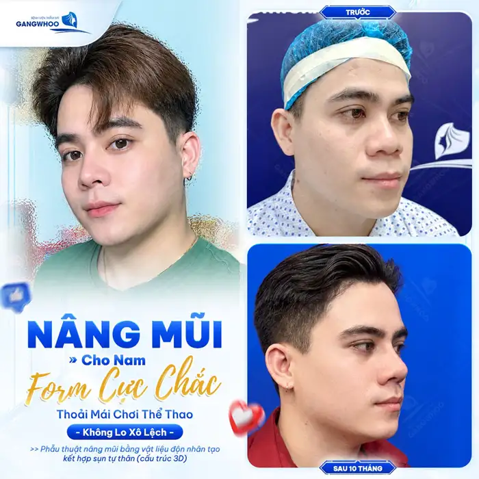 Nam Giới Có Nên Nâng Mũi Không? Giải Đáp Từ Chuyên Gia