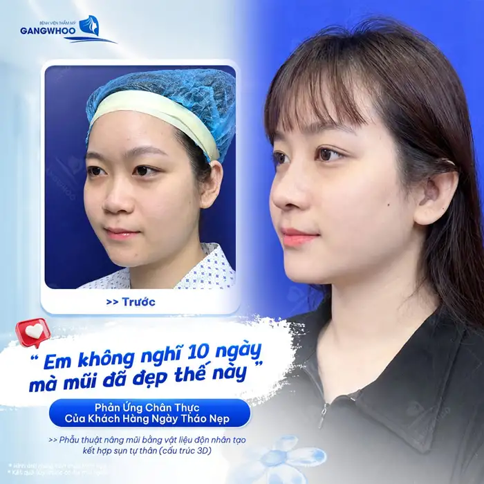 Nâng mũi cấu trúc tháo ra được không?