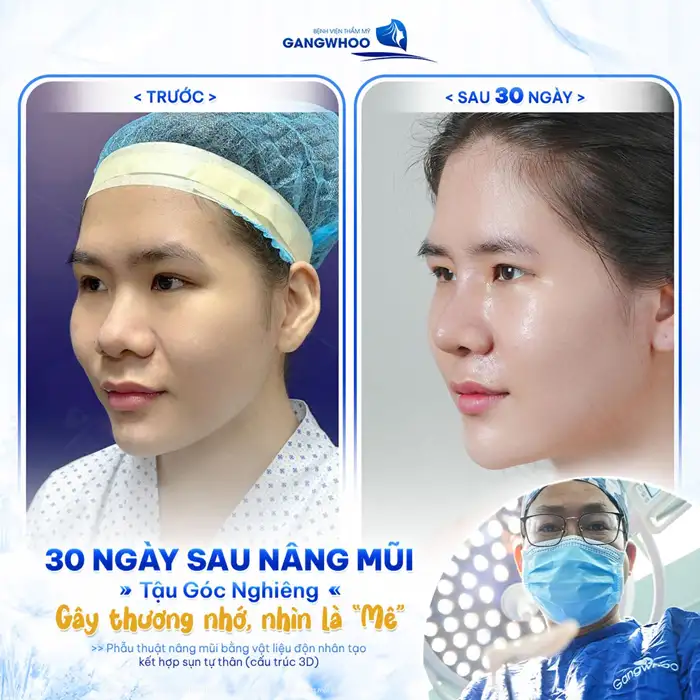 Nâng mũi Surgiform