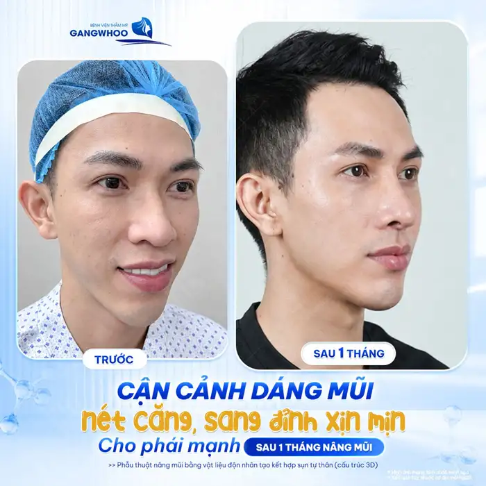 Cơ địa sẹo lồi có nâng mũi được không?