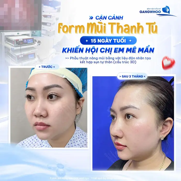 Nâng mũi Surgiform có vĩnh viễn không?