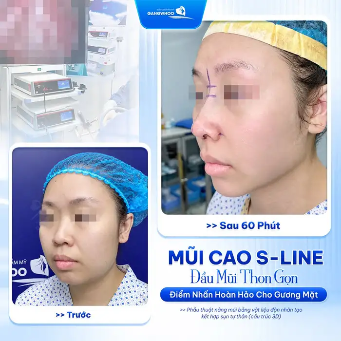 Nâng mũi Surgiform