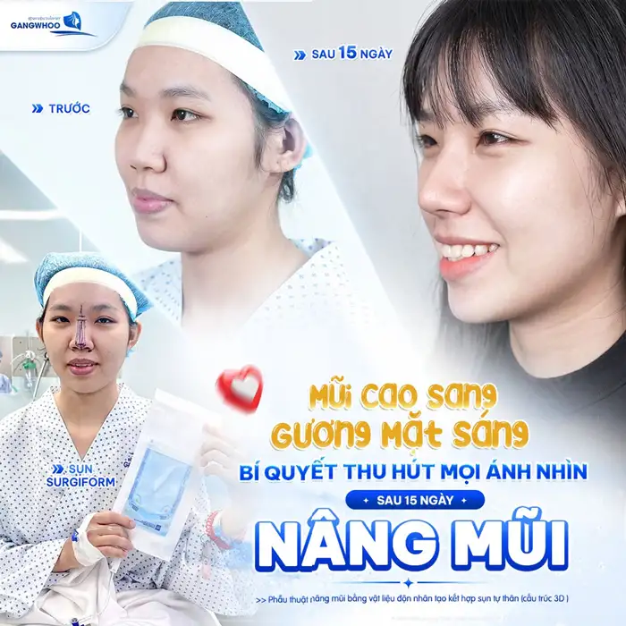 Nâng mũi Surgiform